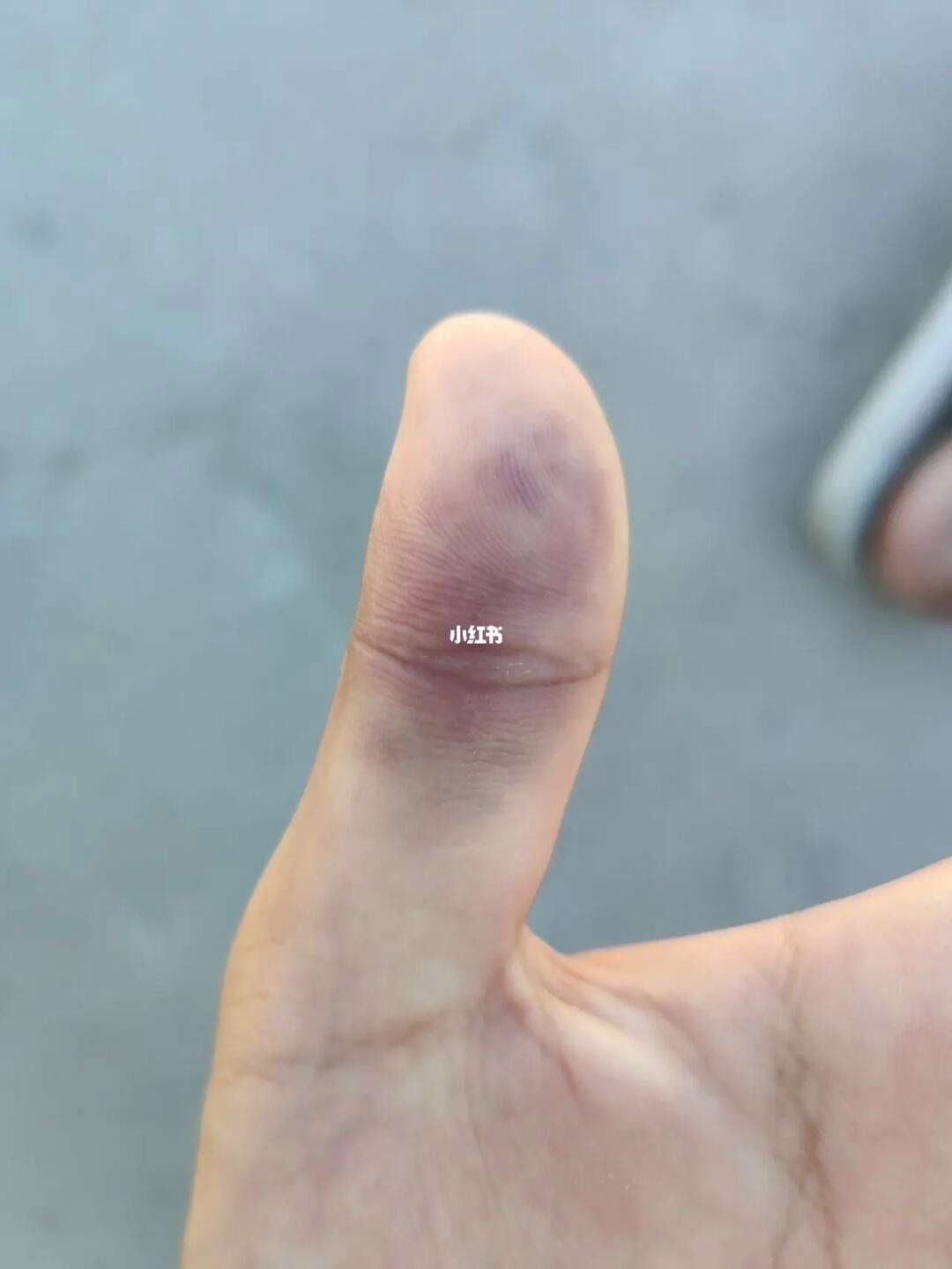 打篮球戳到拇指要几天,打篮球手指戳伤多久能自愈 打篮球戳到拇指要几天,打篮球手指戳伤多久能自愈